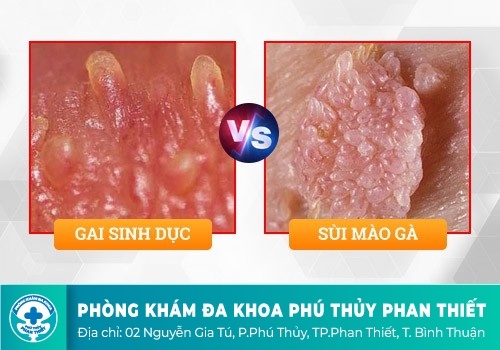 Cách phân biệt sùi mào gà và chuỗi hạt ngọc dương vật