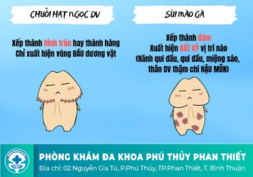 Phân biệt chuỗi hạt ngọc dương vật và sùi mào gà