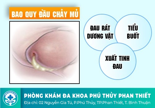 Nhận biết dấu hiệu lậu như thế nào?
