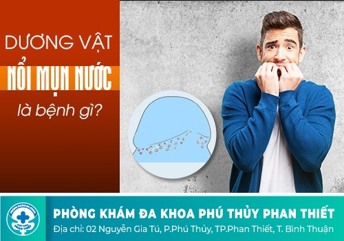 ​   Cu Nổi Mụn Nước Thì Phải Làm Sao