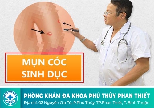 Mụn cóc sinh dục là gì?