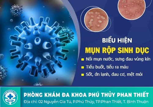 Triệu chứng của bệnh mụn rộp sinh dục ở nam và nữ giới