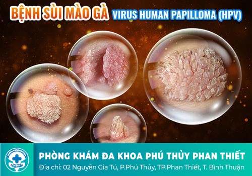 Những điều bạn nên biết về mụn cơm sinh dục