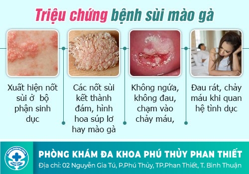 Những triệu chứng của bệnh sùi mào gà