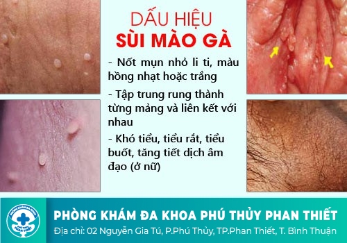 Triệu chứng bệnh sùi mào gà qua từng giai đoạn
