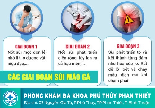 Triệu chứng điển hình của bệnh sùi mào gà ở dương vật