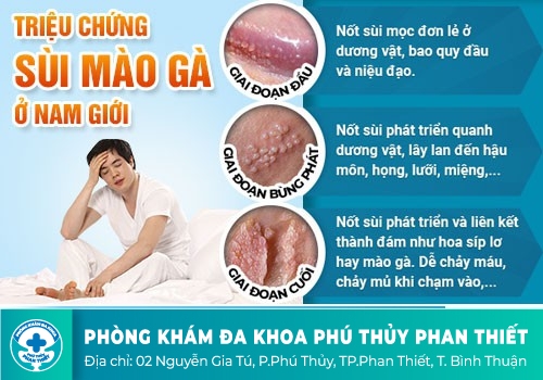 Biểu hiện sùi mào gà ở nam giới