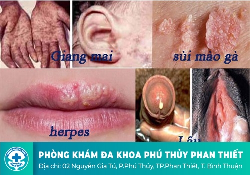 Bệnh lây truyền qua đường tình dục là gì?