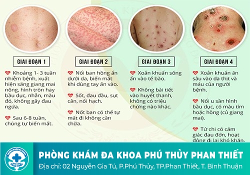 Các giai đoạn của bệnh giang mai