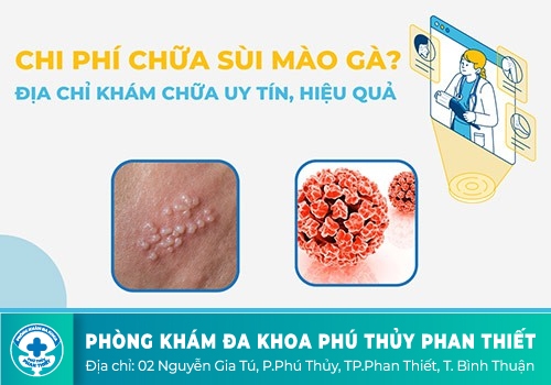 Chi phí chữa sùi mào gà có đắt không?