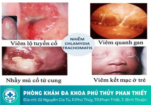 Bệnh Chlamydia