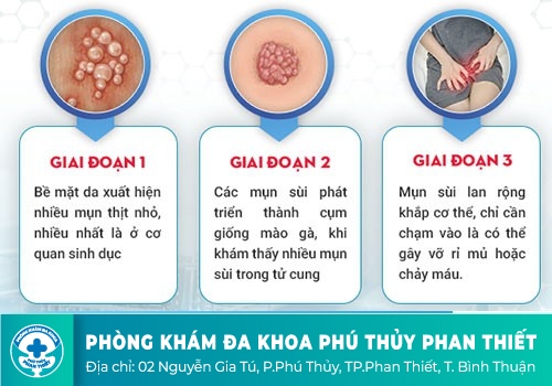 Khi nào cần đi khám bệnh sùi mào gà?