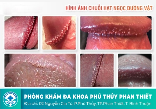 Chuỗi hạt ngọc dương vật có nguy hiểm không?