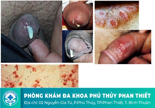 CÁC CĂN BỆNH XÃ HỘI PHỔ BIẾN Ở VIỆT NAM