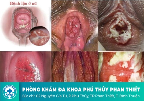 Hình ảnh bệnh lậu ở nam giới