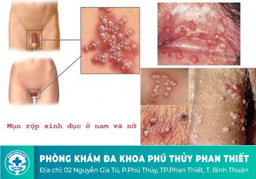 NGUYÊN NHÂN GÂY RA BỆNH MỤN RỤP SINH DỤC?