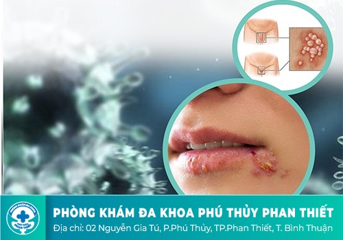 Mụn rộp sinh dục ở miệng rất giống với nhiệt miệng nên nhiều người dễ nhầm lẫn.