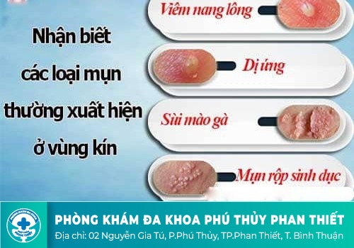 Mọc mụn thịt, mụn cóc, mụn nước ở bộ phận sinh dục nam là bệnh gì?