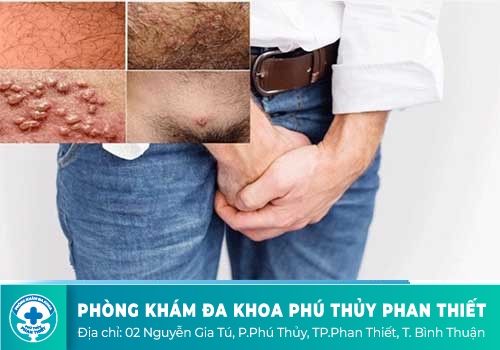 Dương Vật Nổi Mụn Li Ti Là Bệnh Gì?