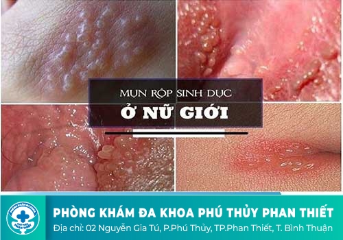 Nổi mụn âm đạo là dấu hiệu của bệnh gì?