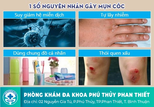 Mụn cóc sinh dục
