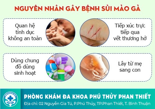 Nguyên nhân gây bệnh sùi mào gà ở cổ tử cung