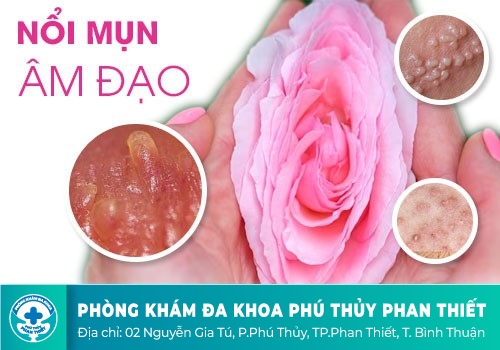 Nổi mụn ở môi lớn, môi bé âm đạo