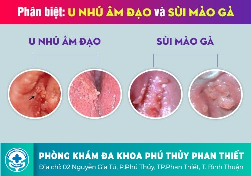 U nhú ở bộ phận sinh dục là dấu hiệu bệnh gì?