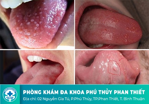 Bạn đã biết gì về sùi mào gà ở lưỡi