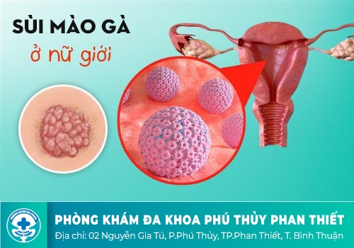 DẤU HIỆU NHẬN BIẾT SÙI MÀO GÀ