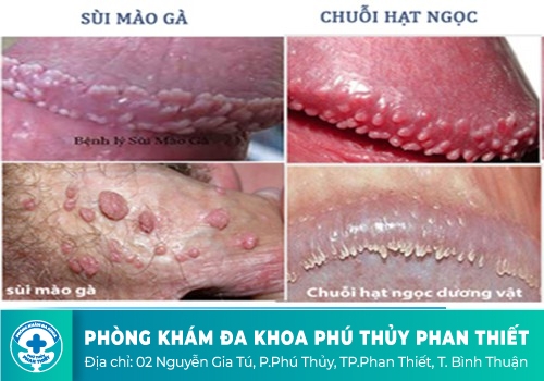 Cách điều trị chuỗi hạt ngọc dương vật