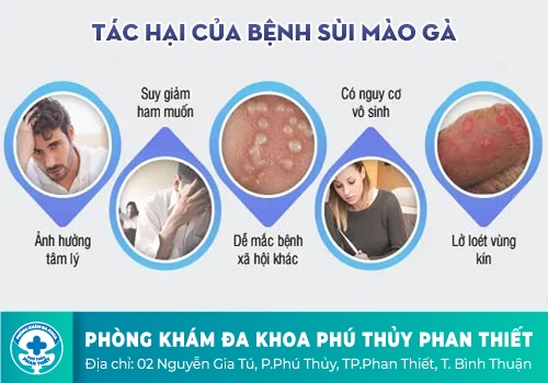 Một số hình ảnh về sùi mào gà
