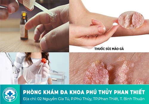 Điều trị sùi mào gà bằng Acid trichloracetic có tốt không