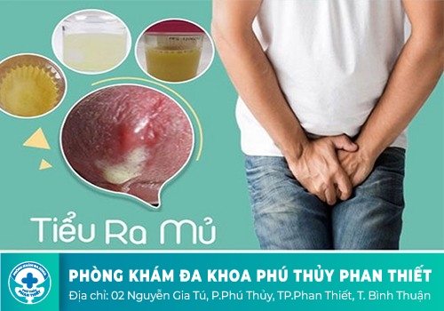 Đi tiểu bị buốt kèm theo có mủ là biểu hiện của bệnh gì?