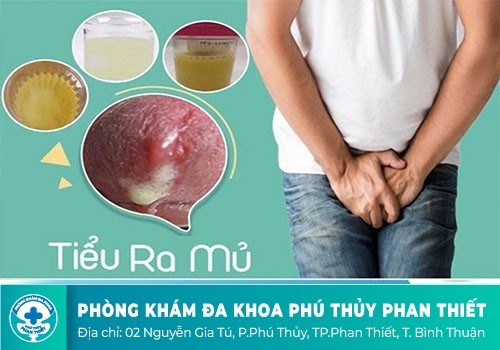 TIỂU RA DỊCH NHẦY CÓ PHẢI BỆNH LẬU KHÔNG