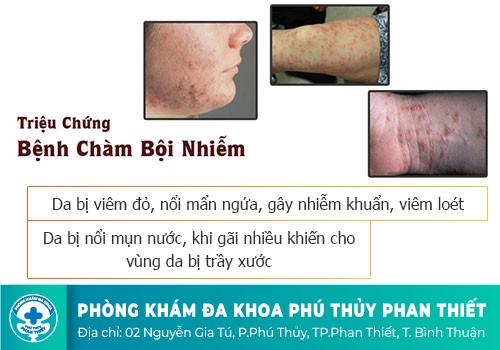 Nổi mụn ở bìu là dấu hiệu của bệnh lý gì?