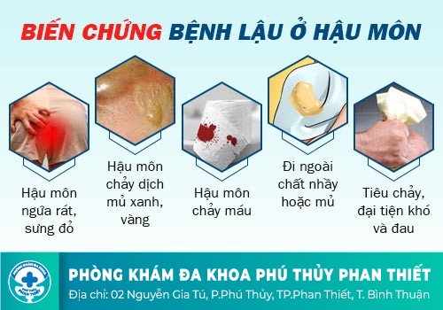 Nhận biết triệu chứng lậu hậu môn chính xác nhất