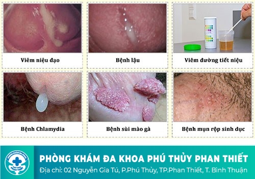 Lý giải nguyên nhân dương vật chảy mủ trắng 