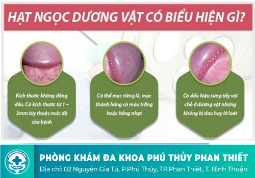 Triệu chứng hạt ngọc dương vật