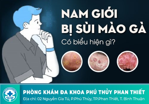 DẤU HIỆU SÙI MÀO GÀ Ở NAM GIỚI