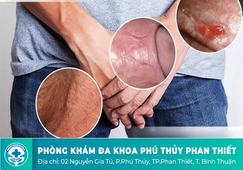Sưng dương vật thì phải làm sao?