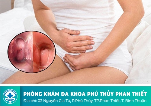 Viêm cổ tử cung