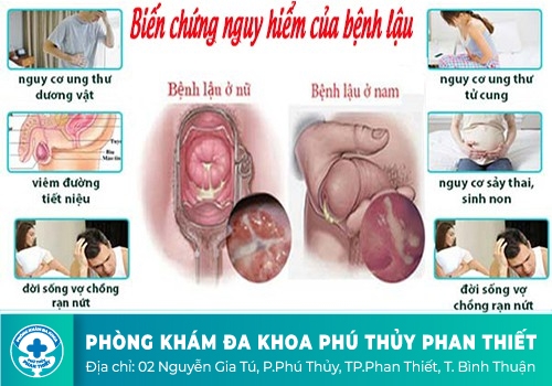 Dương vật chảy dịch, chảy mủ nguy hiểm ra sao?