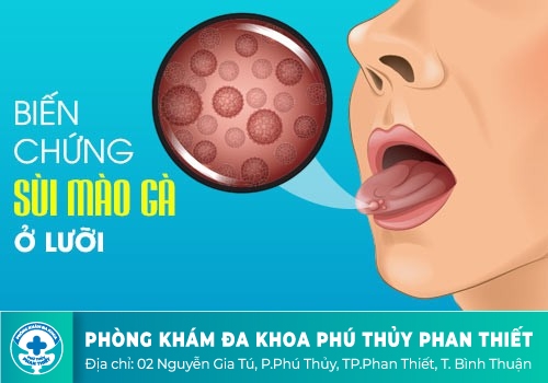 NHỮNG TÁC HẠI KHÔN LƯỜNG TỪ BỆNH SÙI MÀO GÀ Ở HỌNG