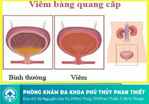 VIÊM BÀNG QUANG CẤP LÀ GÌ?