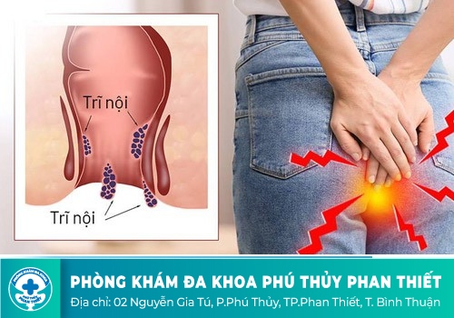 CẢNH BÁO TÁC HẠI NGUY HIỂM KHI BỊ TRĨ NỘI