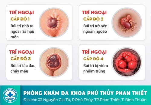 Những tác hại khôn lường của trĩ ngoại khi không chữa trị sớm