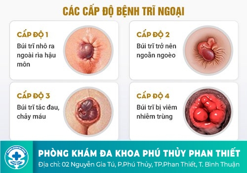 Nhận biết dấu hiệu bệnh trĩ ngoại qua từng giai đoạn