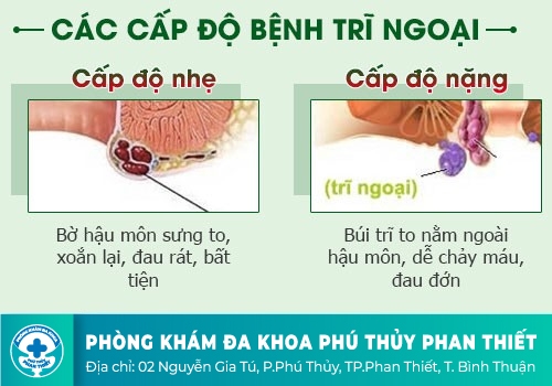 BỆNH TRĨ NGOẠI LÀ GÌ?