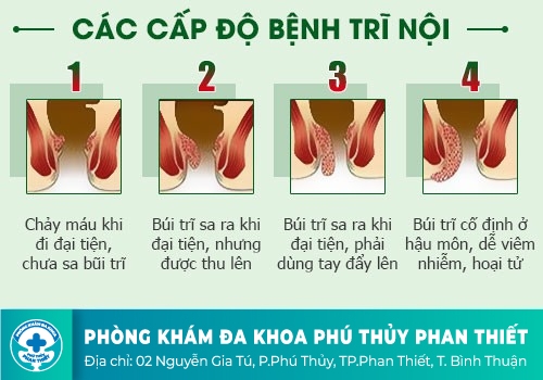 Nhận biết bệnh trĩ nội qua những biểu hiện nào?